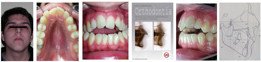 Correction of Anterior Open-Bite  Considering the mandibular Rotational response  : A clinical Case Report